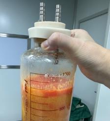 屯昌水动力吸脂手术要做多久？